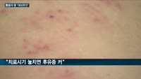 젊은층 '대상포진' 급증…면역력 저하·스트레스가 원인 "예방접종·규칙적 운동 중요"