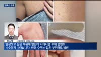 수두·대상포진 등과 비슷한 엠폭스…"감염자와 밀접접촉 피해야"