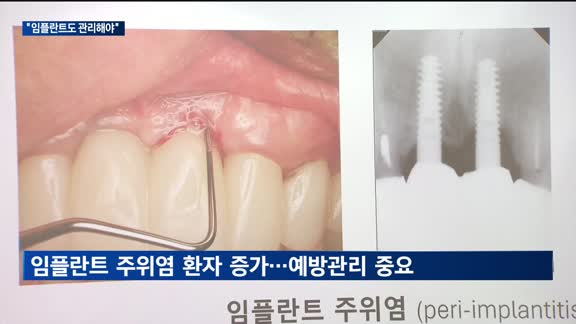 "고령화 시대 잇몸 건강, 임플란트 관리가 좌우"